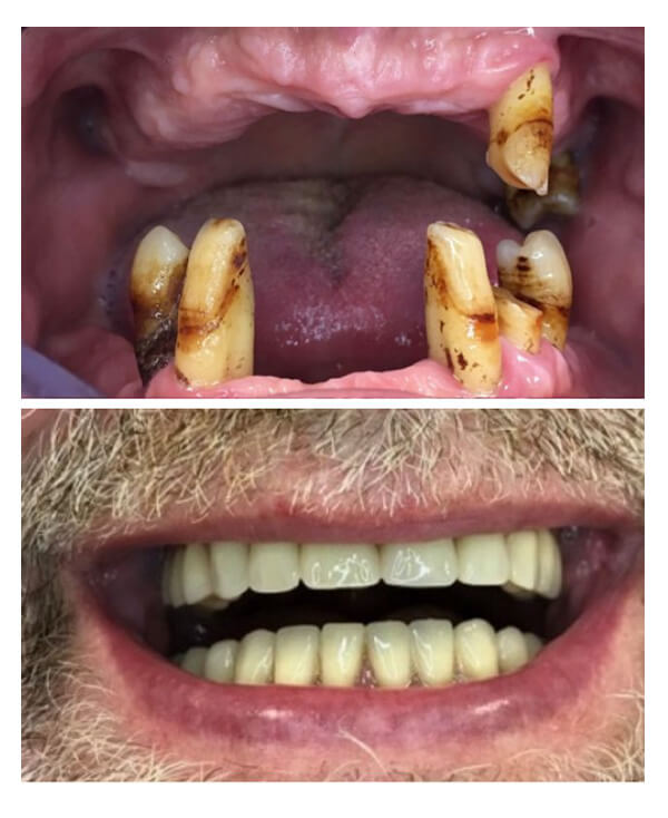 Implanto-protetyka Akademia Dentystów